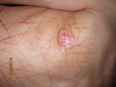 My tits in pain (nipples removed) - N